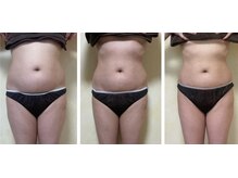 マハロ スコータイ/ビフォーアフター　＜お腹＞