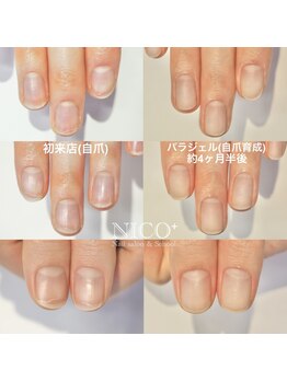 ニコプラス(NICO+)/自爪育成中