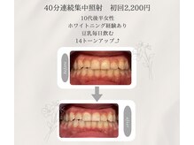 プラスビーセルフ(+b self)/ホワイトニングビフォーアフター