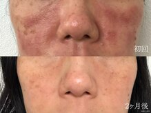 ウォーム(warm)/【どんなお肌悩みも大丈夫】毛穴