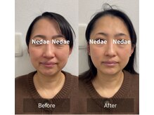 アートデポット ネドアエ(Art depot Nedae)/小顔矯正整顔　before＆after
