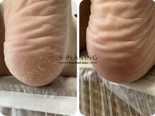 ロンディネ(Rondine)/足裏角質ケア