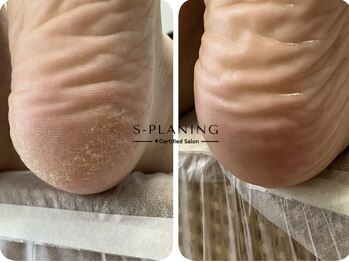 ロンディネ(Rondine)/足裏角質ケア