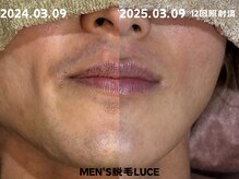 ルーチェ/【ヒゲ脱毛】12回照射