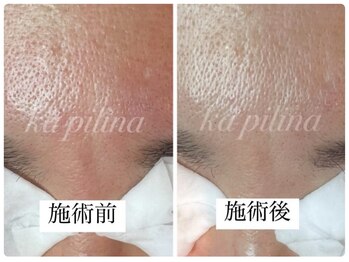 カピリナ(ka pilina)/赤み改善＋毛穴すっきりケア