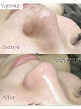 ベロニーク(VERONIQUE)/毛穴洗浄～アクアピーリング～