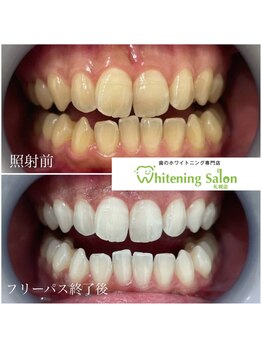 ホワイトニングサロン 札幌店/【ホワイトニング】#札幌#大通り