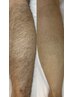 【men's脱毛】ひざ下脱毛