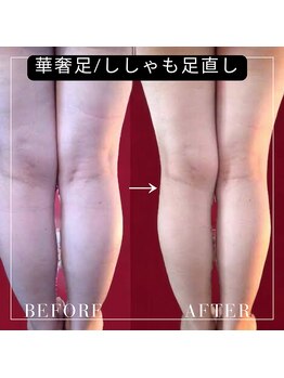 ラグラン銀座メディカルエステ 高輪ゲートウェイ店/華奢脚/ししゃも足直し
