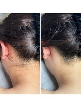 インベスト(INVEST)/うなじ脱毛