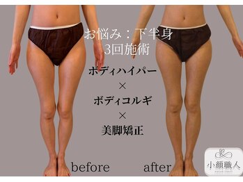 小顔職人/ボディビフォーアフター/30代