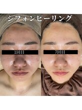 ウィズティ(with.T)/シフォンピーリング