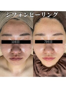 ウィズティ(with.T)/シフォンピーリング