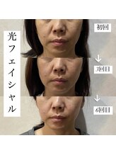 アース コアフュールボーテ 新潟紫竹山店(EARTH coiffure beaute)/光フェイシャル