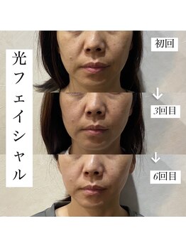 アース コアフュールボーテ 新潟紫竹山店(EARTH coiffure beaute)/光フェイシャル