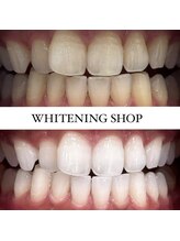 ホワイトニングショップ 熊谷店/【垢抜け効果抜群】