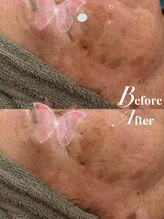 リリーミー(Rily Me)/光フェイシャルシミフィルター