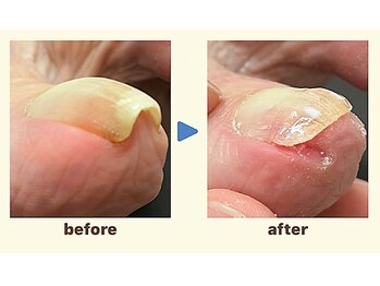 かがわ接骨院 高松伏石院/巻き爪でお悩みの方へ！