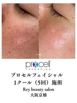 レイ(Rey)/プロセルフェイシャル頬の毛穴