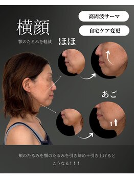 シェリー(Cherie)/必要な脂肪を残したたるみケア