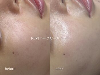 ブルーム(bloom.)/陶肌トリートメントbefore/after