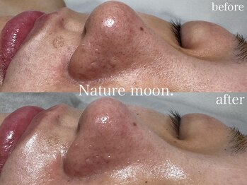 ナチュールムーン(Nature moon.)/毛穴洗浄