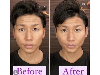 スイスパ(翠SUI SPA)/【小顔矯正】小顔 Before→After