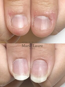 マリーロール 梅田店(Marie Laure)/自爪育成/深爪矯正/ネイルケア