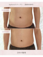 スフィア(Sphere)/ビフォアフ：脂肪冷却　男性も可