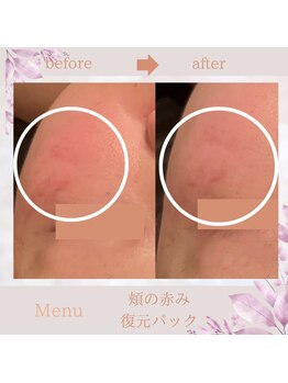 エングロー(Englow)/絶対美白！話題の復元パック