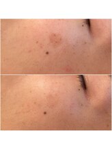 シェリモ(CHERIMO)/しみ改善ケア6回目の結果