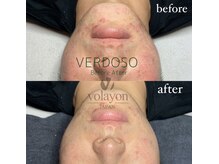 ペイジ(peige)/【peige】症例写真