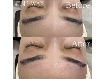 TD 一宮店/眉周り産毛WAX脱毛Before→After