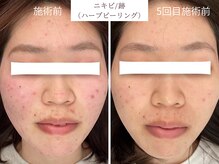 ヒジ(Life Salon)/お顔ハーブピーリング