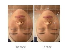 エクシア(ECXIA)の雰囲気（小顔コルギのbefore after）