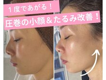 フェイスラインのもたつき、2重顎がキュッと引き締まる♪