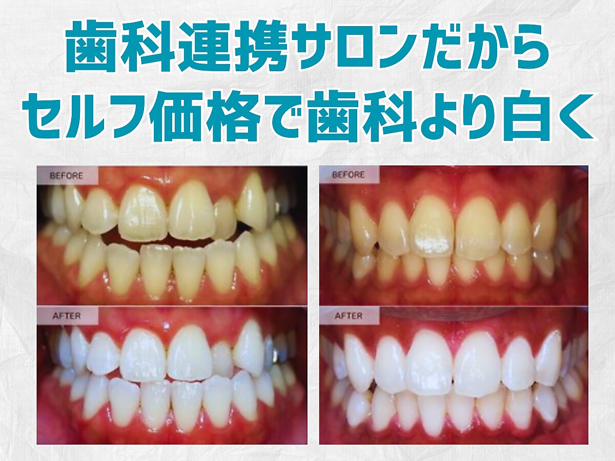 【医療提携】ホワイトニングメニュー導入　単品可 医療提携】ホワイトニングメニュー導入 単品可 医療提携