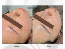 アン ビューティー(ann beauty)/施術1回【症例写真】20代