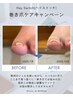 Hey Switch巻き爪ケア キャンペーン 【特別価格¥6,000!!】