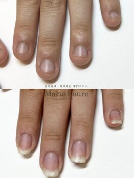 マリーロール 梅田店(Marie Laure)/自爪育成/深爪矯正/ネイルケア