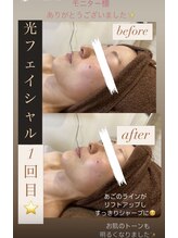 サロン ルアナ(salon luana)/光フェイシャル　before→after