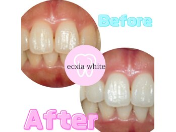 エクシアホワイト 広島袋町店/ホワイトニングビフォーアフター