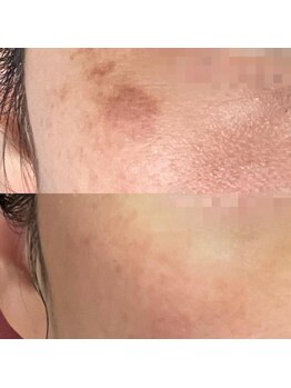 カラット ベル店(KARAT)/シミケアトリートメント