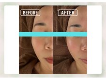 サロン ド メタセコイア(salon de Metasequoia)/筋膜リフト／before☆after