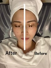 ナラビューティー(NARA BEAUTY)/全顔2回目効果　小顔恵比寿