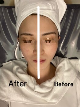 ナラビューティー(NARA BEAUTY)/全顔2回目効果 小顔恵比寿