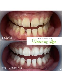 ホワイトニングサロン 札幌店/【ホワイトニング】#札幌#大通り
