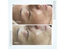 シャルムパリス(charme paris)/毛穴×美白♪１回の施術変化