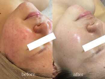 グランヴェルジェ(Granverger)/陶肌トリートメント