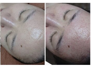 ノヴェイル(NoVeil)/Before/After